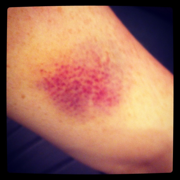 ugly Chemo bruise